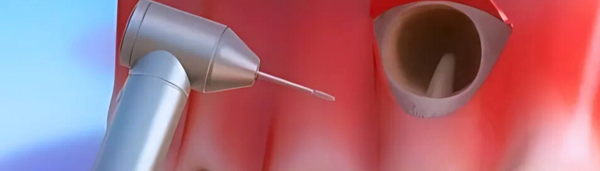 Apicectomia - S-Medical Group Sora - Formato Desktop