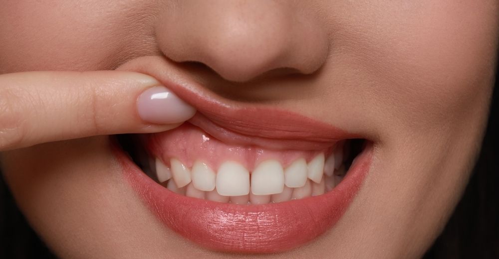 Apicectomia - S-Medical Group Sora - Formato Foto Testo