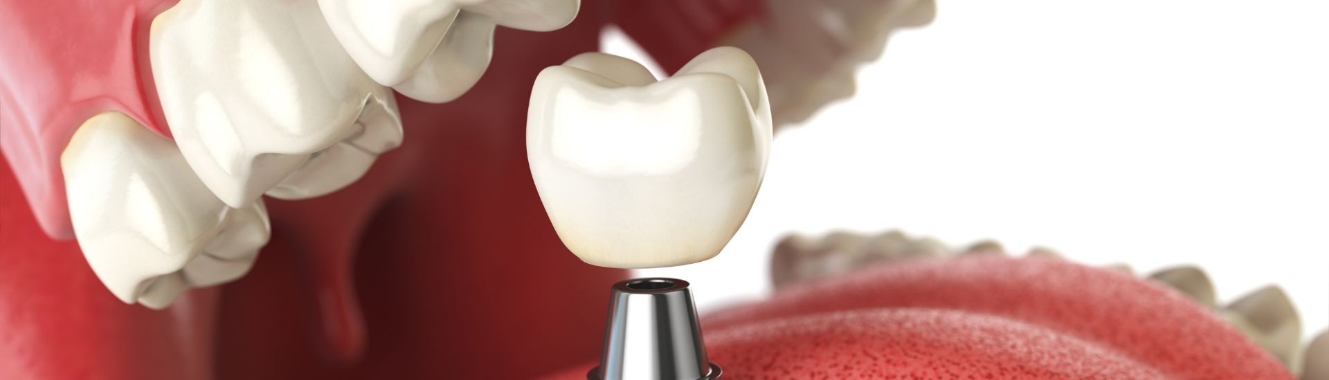 Corona Dentale - S-Medical Group Sora- Formato Desktop