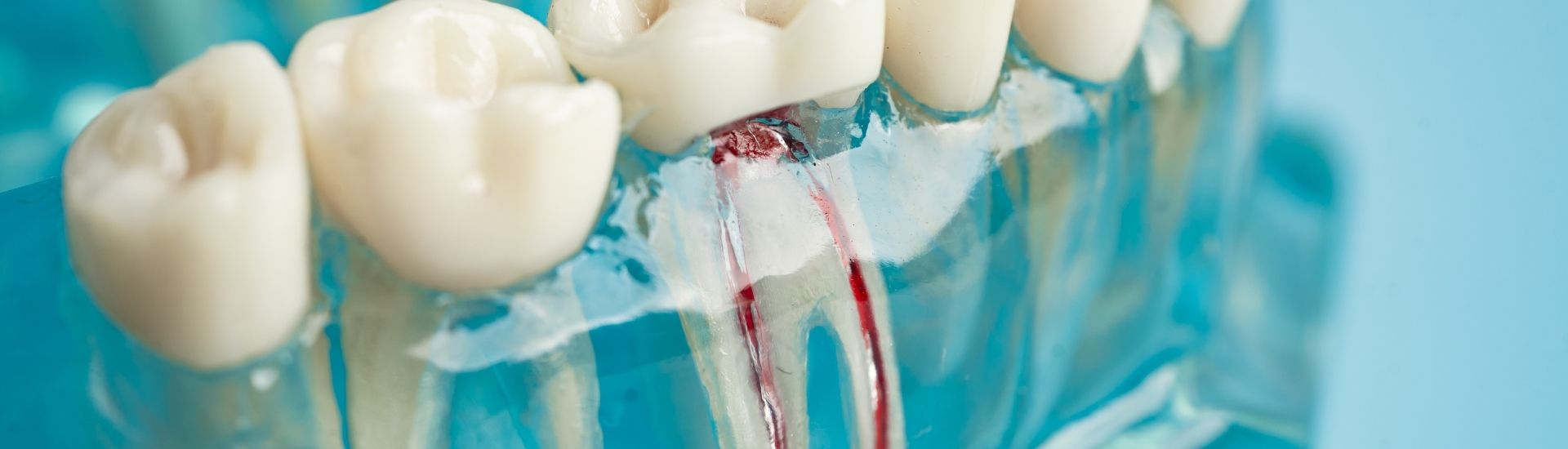 Devitalizzazione dentale - S-Medical Group Sora- Formato Desktop