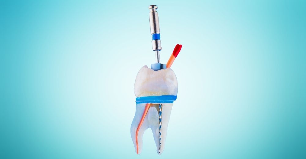 Devitalizzazione dentale - S-Medical Group Sora- Formato Foto Testo