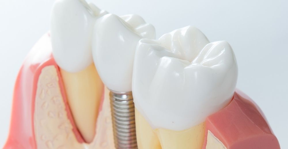 Implantologia a carico immediato - S-Medical Group Sora - Formato Foto Testo