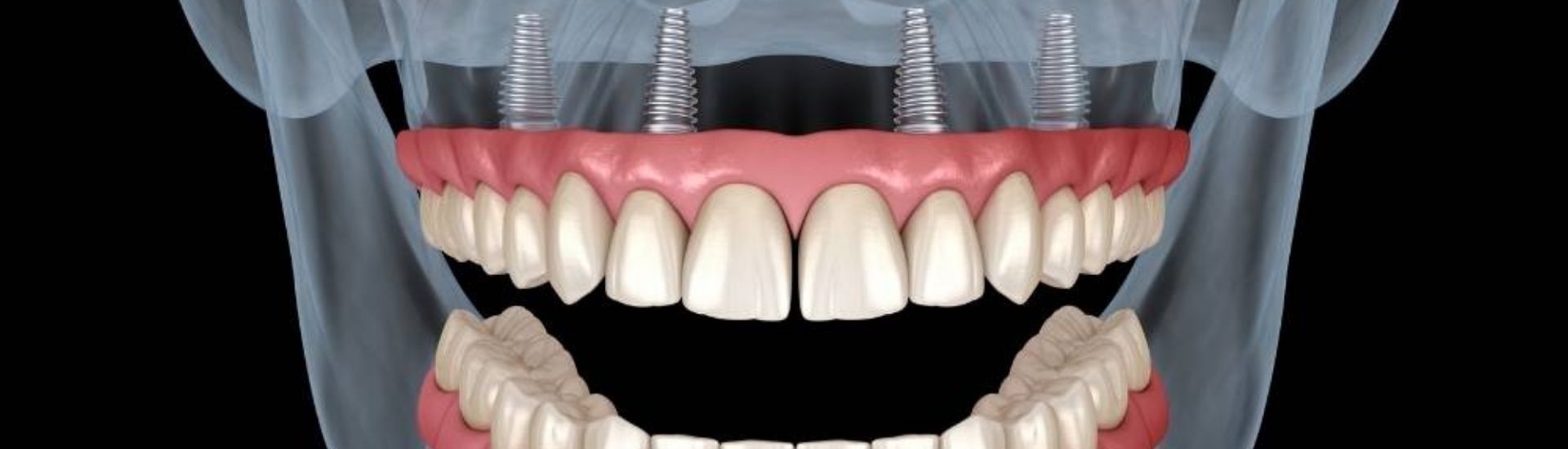 Implantologia all on four -S-Medical Group Sora - Formato Desktop