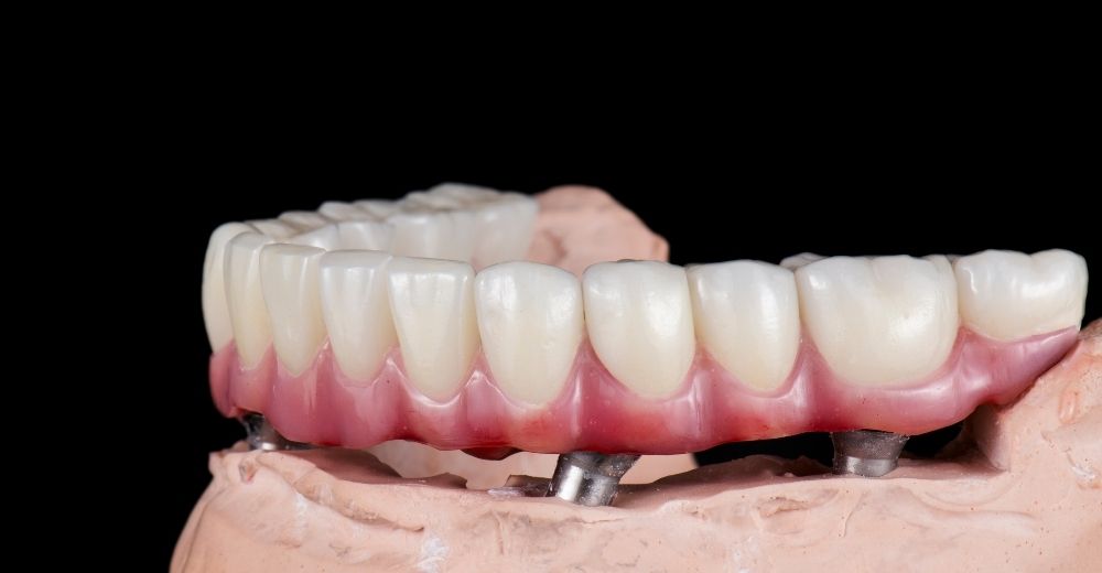 Implantologia all on four -S-Medical Group Sora - Formato Foto Testo