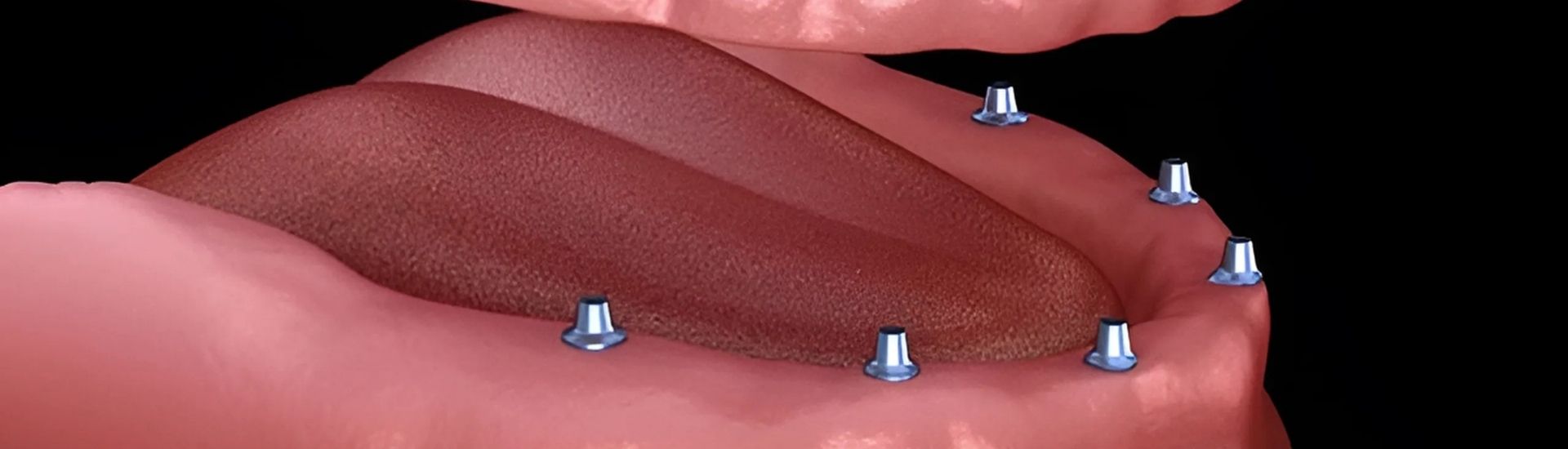 Implantologia all on six - S-Medical Group Sora