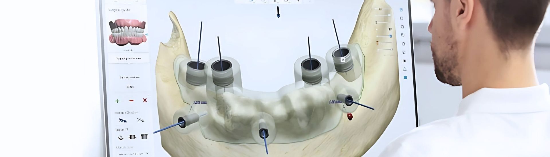 Implantologia computer guidata - S-Medical Group Sora - Formato Desktop