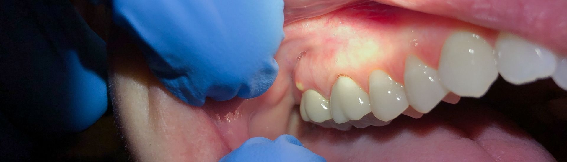 Incisione di ascessi - S-Medical Group Sora - Formato Desktop