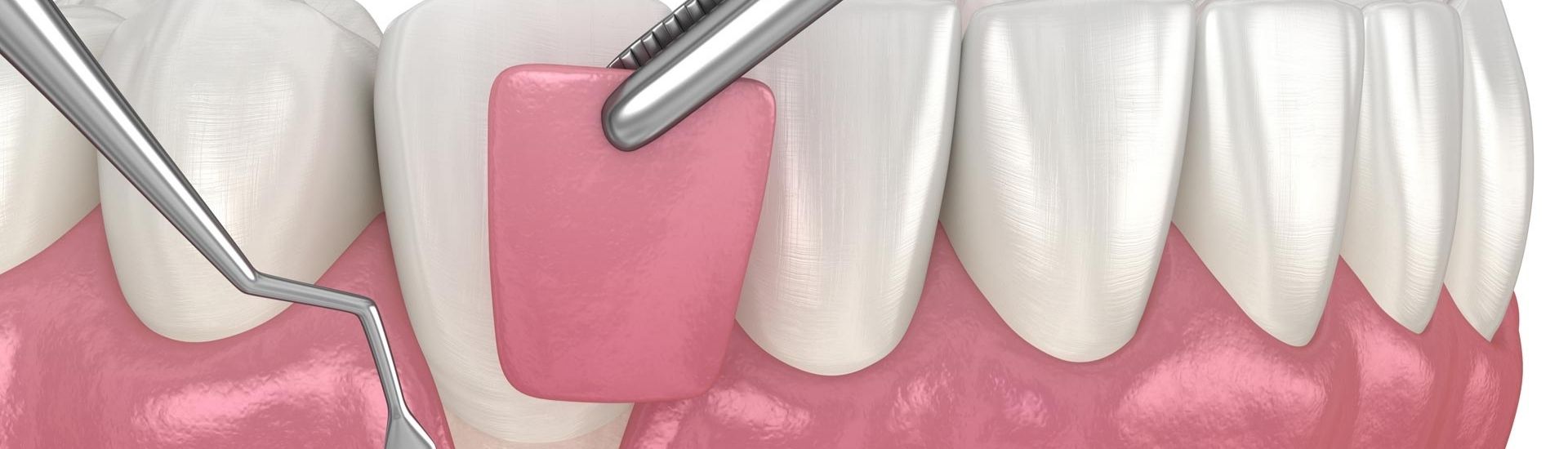 Innesto gengivale eterologo - S-Medical Group Sora - Formato Desktop