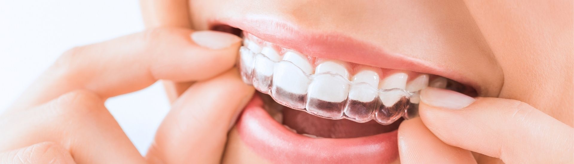 Ortodonzia invisibile - S-Medical Group Sora Formato Desktop