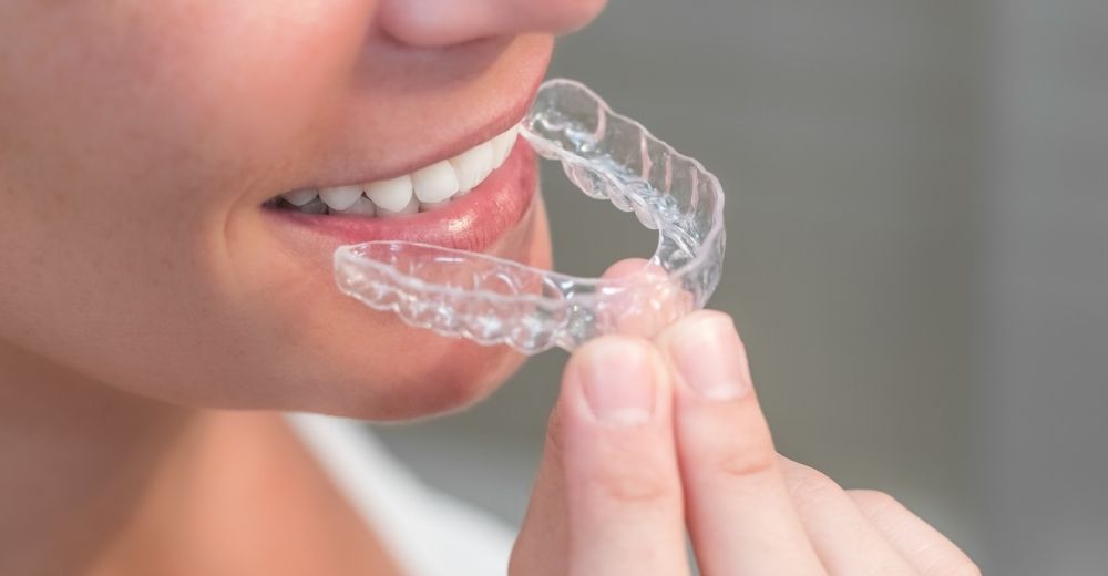 Ortodonzia invisibile - S-Medical Group Sora - Formato Foto Testo