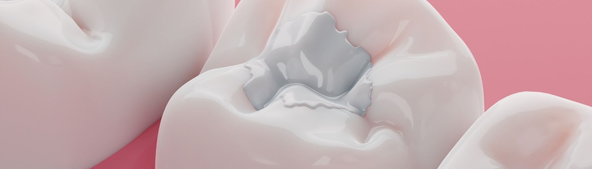 Otturazione dentale - S-Medical Group Sora- Formato Desktop