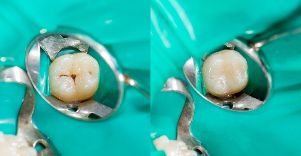 Otturazione dentale - S-Medical Group Sora - Formato Foto Testo