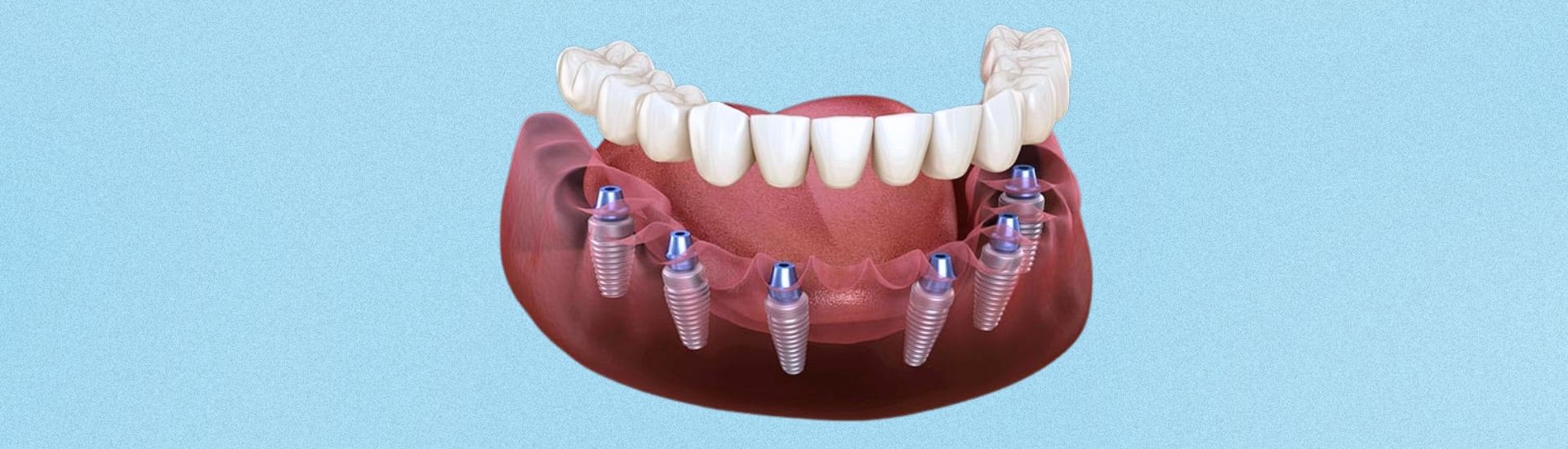 Protesi di toronto - S-Medical Group Sora - Formato Desktop