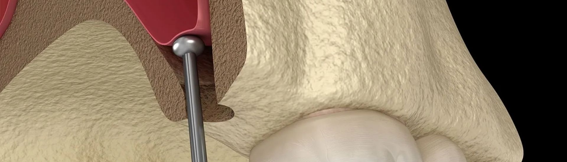 Rialzo del seno mascellare - S-Medical Group Sora - Formato Desktop