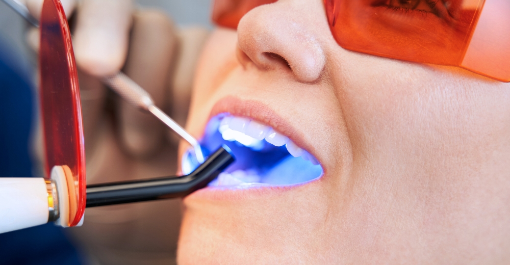 Sigillatura Dentale - S-Medical Group Sora - Formato Foto Testo