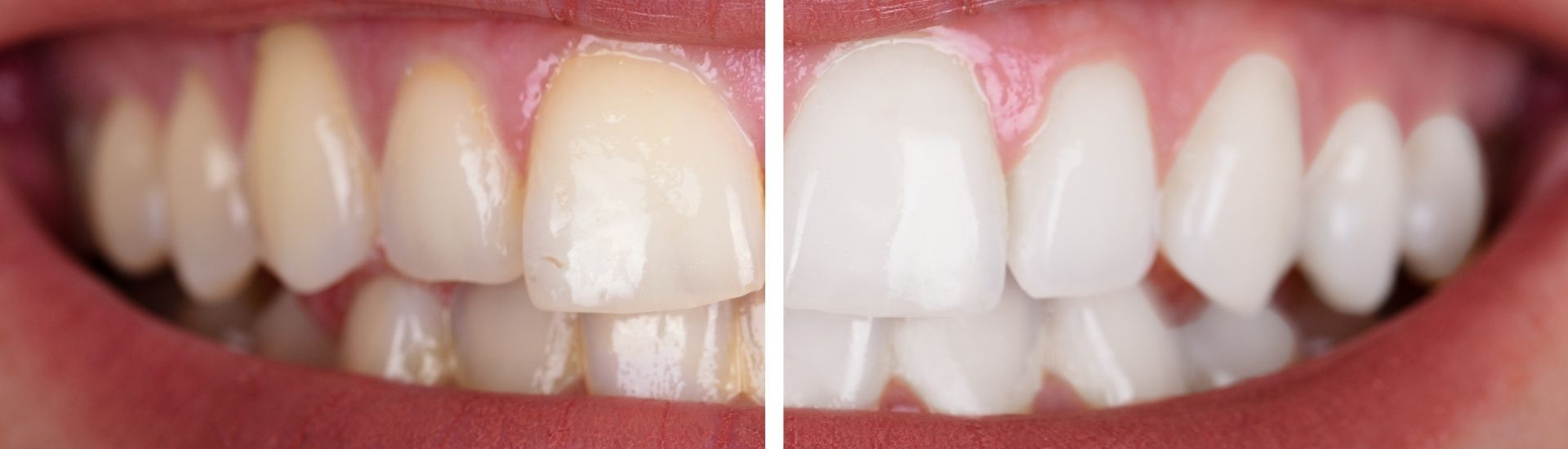 Trattamento delle macchie bianche dello smalto - S-Medical Group Sora- Formato Desktop