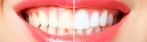 Ablazione del tartaro e pulizia dentale professionale presso S-Medical di Sora