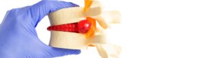 Scopri di più sull'articolo Spondilolistesi a Sora | S-Medical