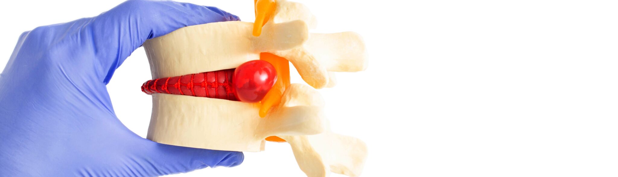 Scopri di più sull'articolo Spondilolistesi a Sora | S-Medical