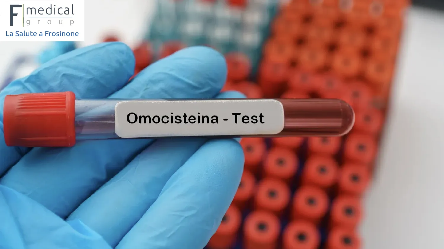 Scopri di più sull'articolo Analisi dell’omocisteina a Sora | S-Medical Group